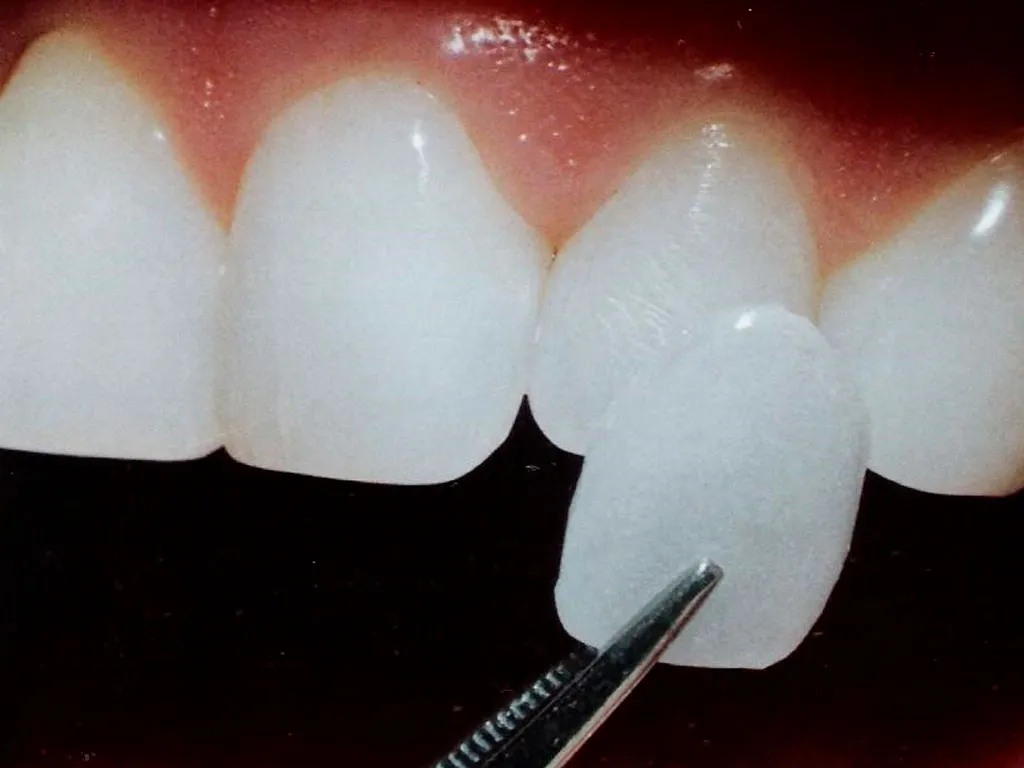 Dental Veneers in Guadalajara ProClinic Dental Best dentist